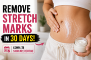 How to Remove Stretch Marks in 30 Days: Complete Skincare Routine