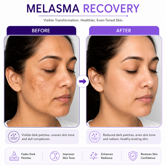 LASS Melasma Recovery Routine