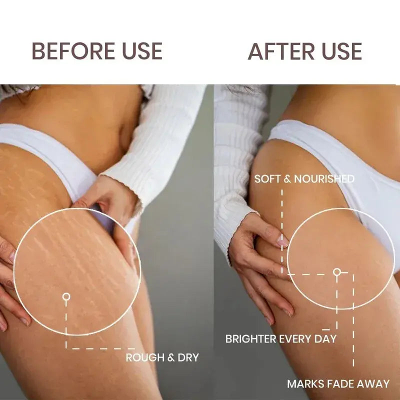 Lass Natural Stretch Mark Care Roll-On Serum with Striover™ – 50 ml