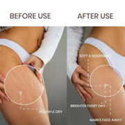 Lass Natural Stretch Mark Care Roll-On Serum with Striover™ – 50 ml