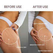 Lass Natural Stretch Mark Care Roll-On Serum with Striover™ – 50 ml